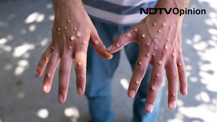 (Download link) Is India Really At Risk Please safeOf A Monkeypox Outbreak viral video